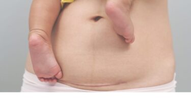 Mýty o cisárskom reze