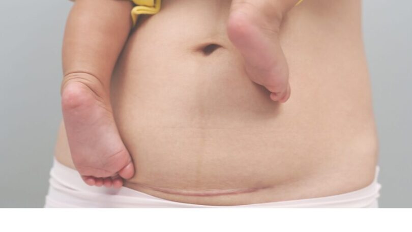 Mýty o cisárskom reze